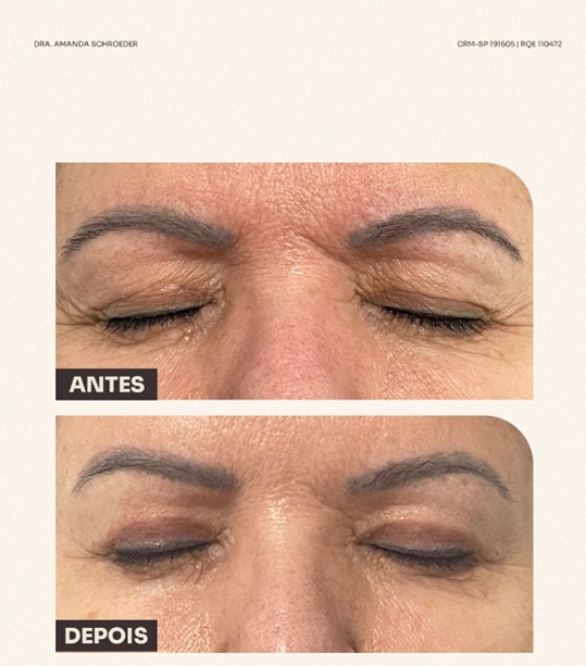 Imagem educativa de antes e depois de blefaroplastia