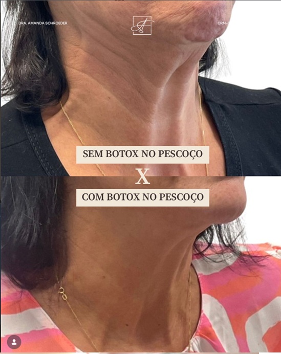 Imagem educativa de tratamento estético no pescoço