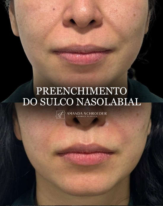 Imagem educativa de preenchimento facial